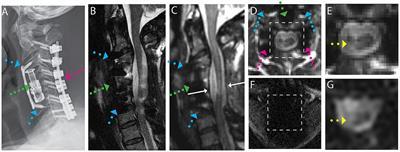 Diffusion-weighted MRI of the spinal cord in cervical spondylotic myelopathy after instrumented fusion